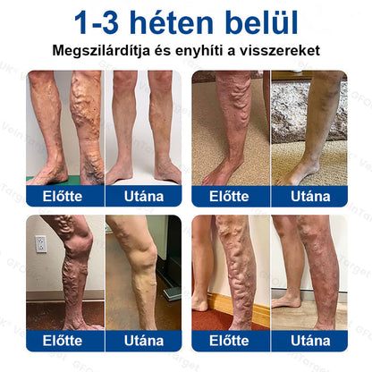 ✅Laleia® Vein Ease mikrotűs tapasz