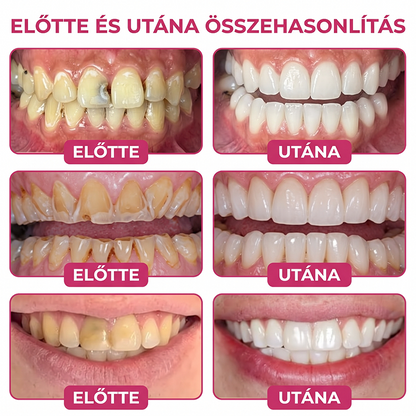 Rolimey® DenPerm – Természetes, zománcpótló gél szuvas léziók kezelésére🎃