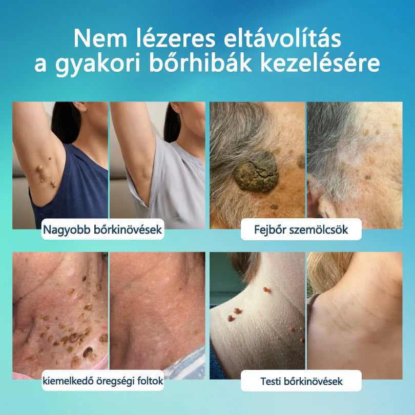 Timilk® SpotlessPro Fejlett Bőrápoló Toll-🔥
