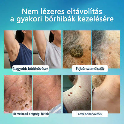 Timilk® SpotlessPro Fejlett Bőrápoló Toll-📦