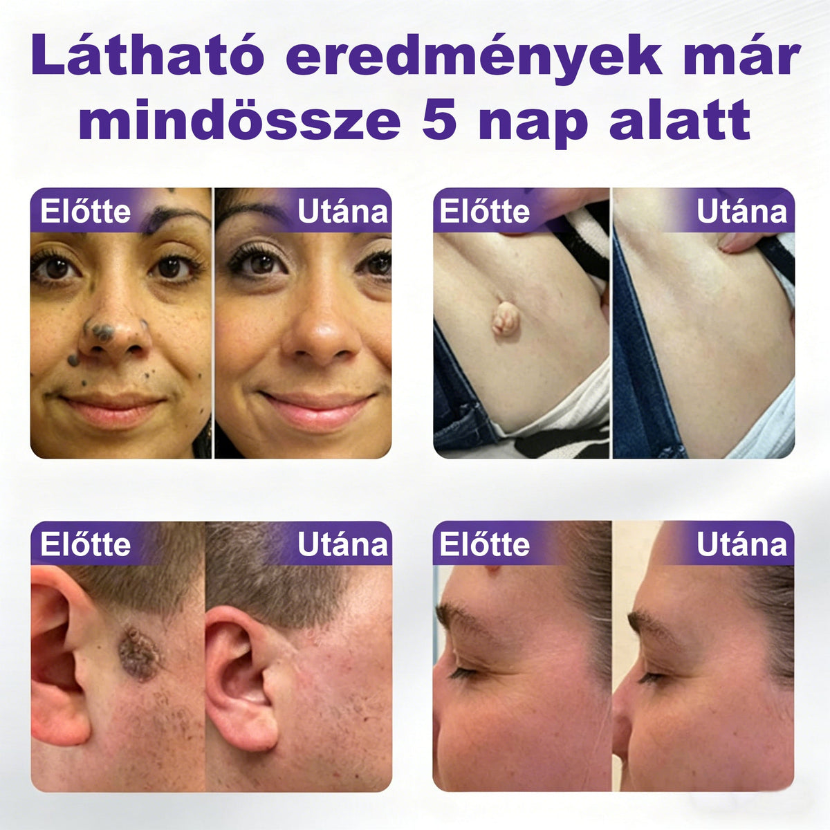 CleraNaure® mikrotűs szemölcs- és anyajegyeltávolító tapasz-🔥