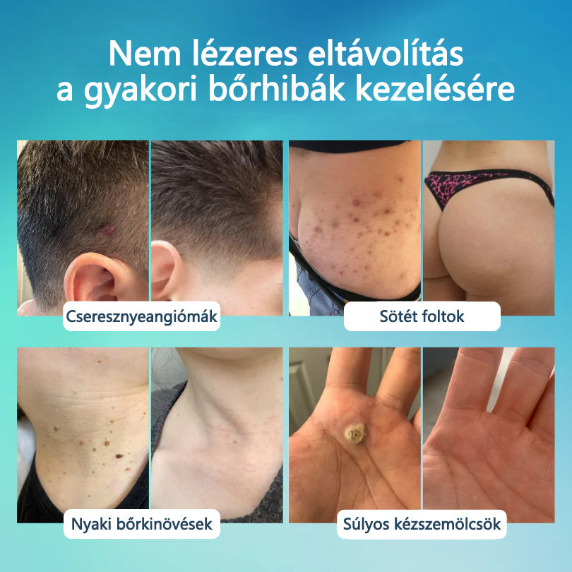 Timilk® SpotlessPro Fejlett Bőrápoló Toll-📦