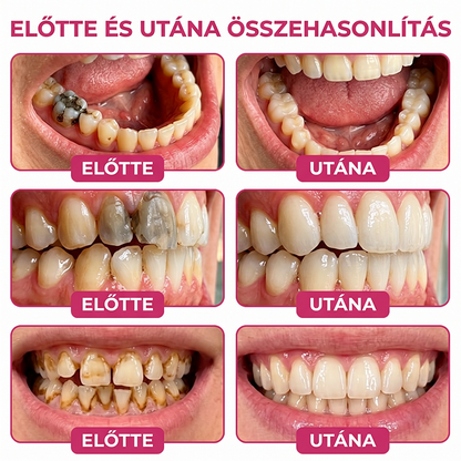 Rolimey® DenPerm – Természetes, zománcpótló gél szuvas léziók kezelésére🎃