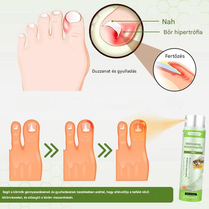 🔥🐝Korlátozott ideig 50%-os kedvezmény | Foulme® NailRescue Méhméreg Spray🐝